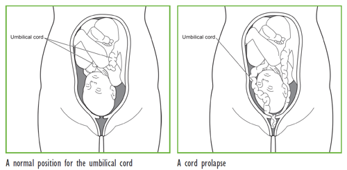 Umbilical cord prolapse in late pregnancy