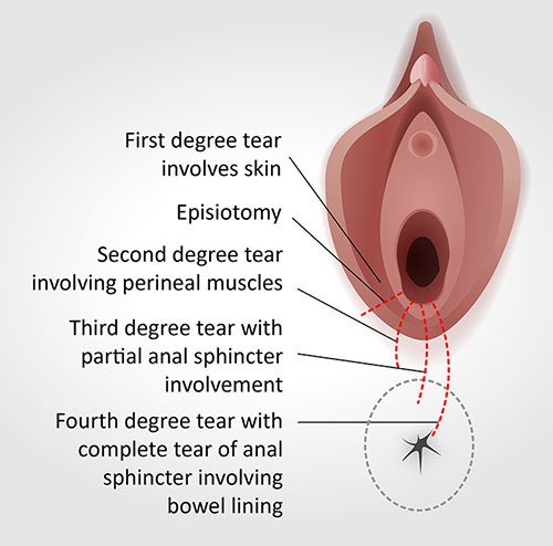 Image 2: Types of tears that can occur
