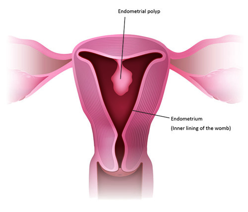 [Image] A polyp inside the uterus which may be removed during hysteroscopy:
