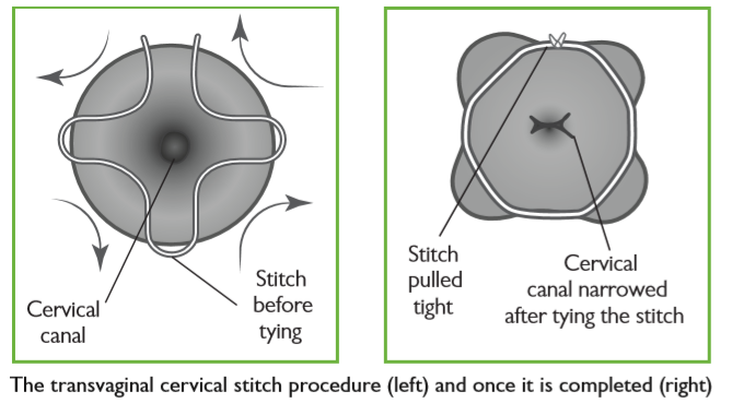 Figure 1 from Transvaginal cervical cerclage: evidence for perioperative  management strategies. | Semantic Scholar